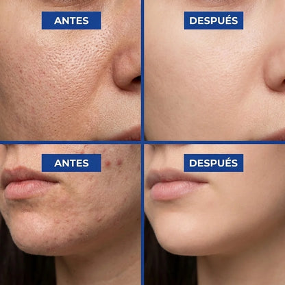VELYN™ Oferta Pads Anti-Poros + Efecto Piel Lisa y Refinada